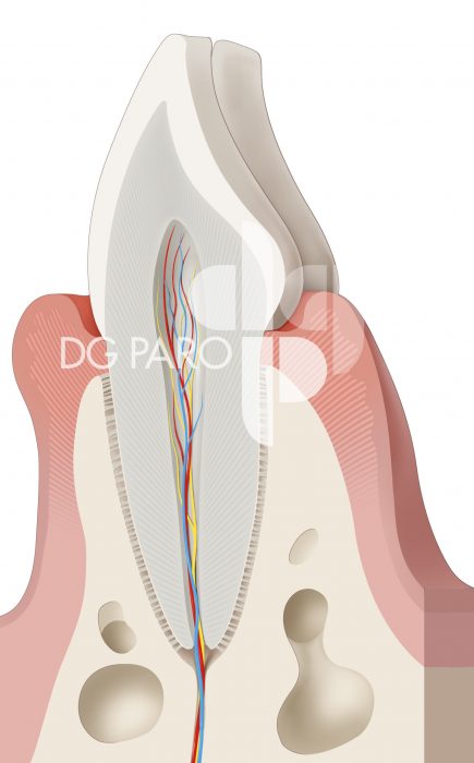 Zahn mit einer Gingivitis (Zahnfleischentzündung)