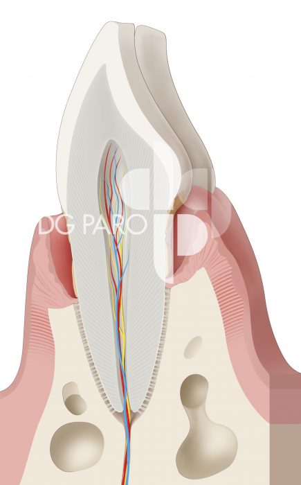 Zahn mit ausgeprägter Zerstörung des Pardons (Zahnhalteapparat)