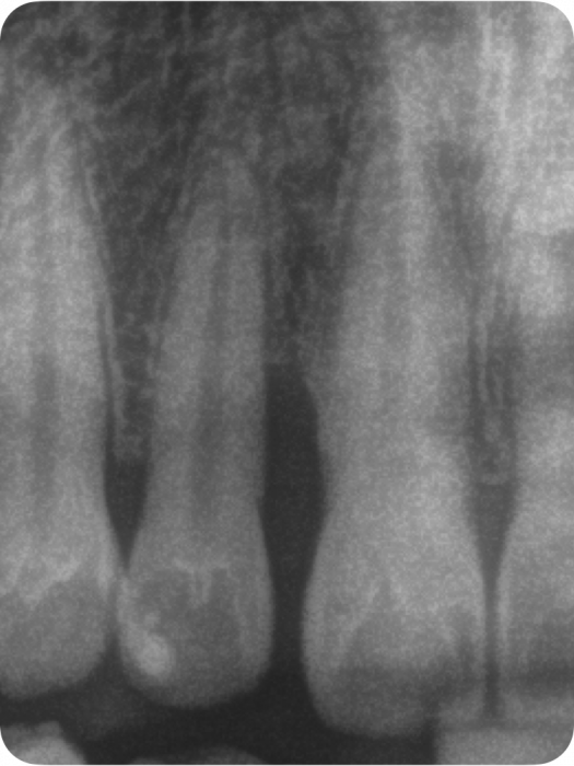 Knochenabbau durch Parodontitis