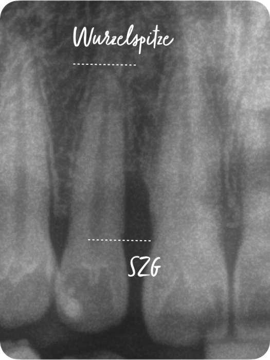 Bestimmung Knochenabbau